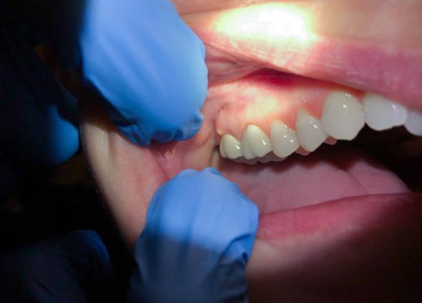 Best Emergency Gum Pain Relief  in Paincourtville, LA